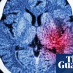 Algorithm could help prevent thousands of strokes in UK each year