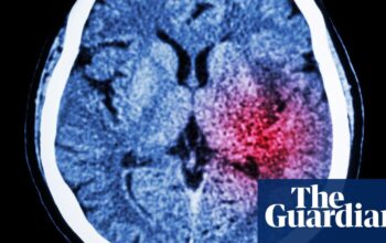 Algorithm could help prevent thousands of strokes in UK each year