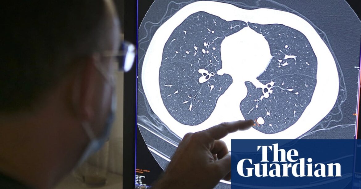 NHS in England urged to become ‘early intervention service’ on cancer