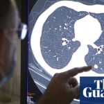 NHS in England urged to become ‘early intervention service’ on cancer