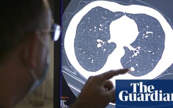 NHS in England urged to become ‘early intervention service’ on cancer